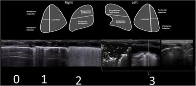 Lung Ultrasound Characteristics in Neonates With Positive Real Time Polymerase Chain Reaction for SARS-CoV-2 on a Tertiary Level Referral Hospital in Mexico City